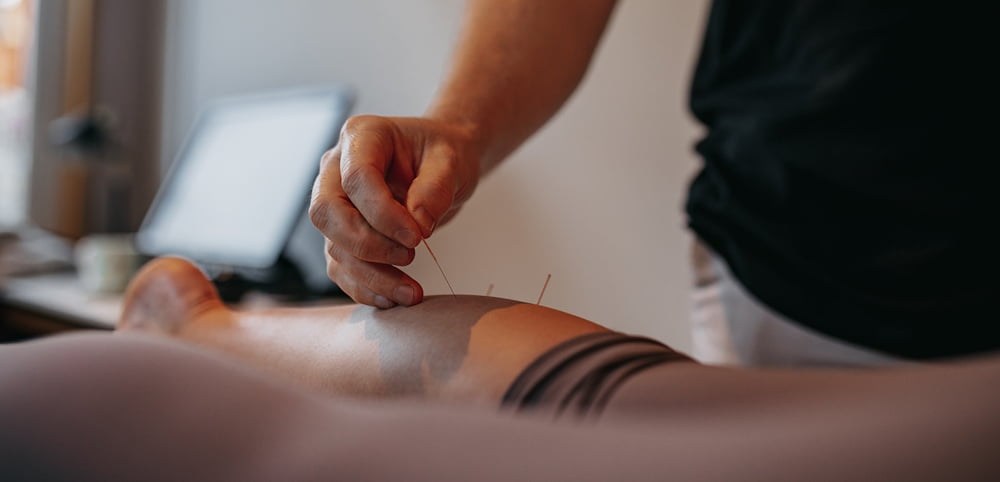 Medical Acupuncture in Northampton at the Movement Clinic is the use of fine needles to stimulate sensory nerves in muscles