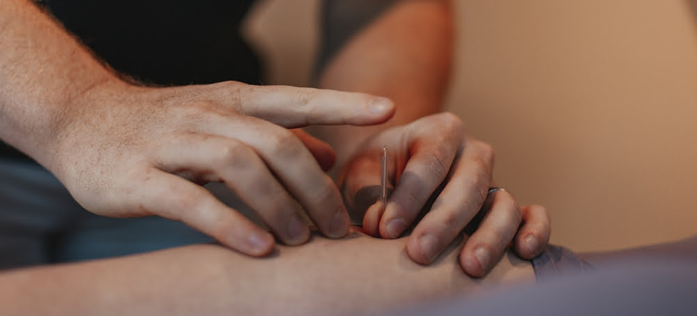 What is Medical Acupuncture? Movement Clinic in Northampton are expert in this medicine free form of pain relief