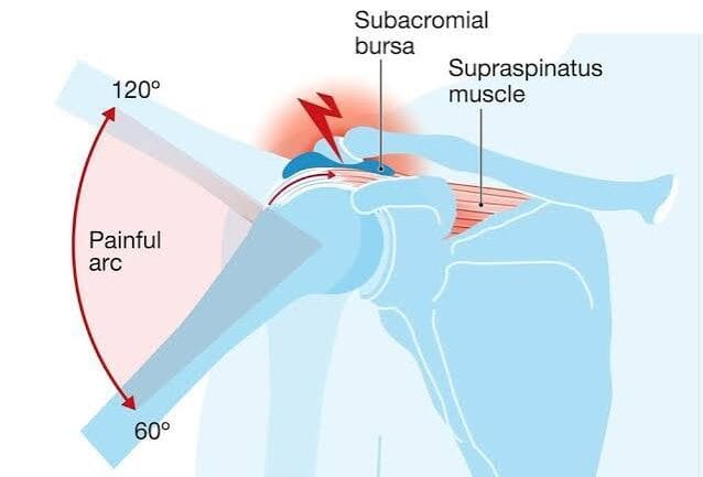 Diagram showing painful arc in sub-acromial impingement