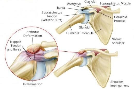 Sub-acromial impingement of the shoulder joint